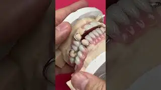 Class-2 Titanium Partials 