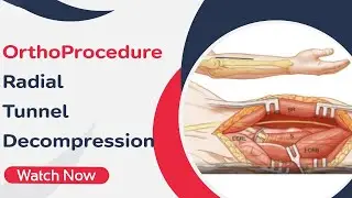 OrthoProcedure - Radial Tunnel Decompression