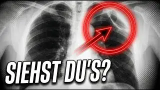 🧐 Pneumothorax im Röntgen - ein Beispielfall mit systematischer Befundung #radiologie #lernen