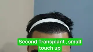 24 MONTHS Hair transplant Update - Motion Hair Clinic, Gangnam