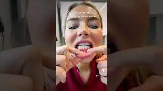 Frenum attachment! #doctor #frenum #frenumattachment #gingivalrecession