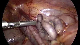 Acute appendicitis in pediatrics| Laparoscopic appendectomy