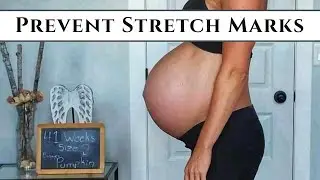 3 Tips to AVOID Postpartum Stretch Marks that WORKED for Me
