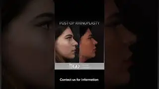 Before and after rhinoplasty - Dr Guncel Ozturk 