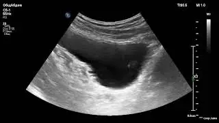 УЗИ мочевого пузыря. Опухоль. Ultrasound. Bladder. Tumor.