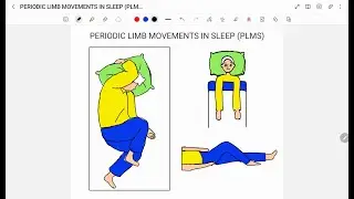 PERIODIC LIMB MOVEMENTS IN SLEEP (PLMS)