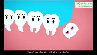 Không phải Răng Khôn nào cũng phải nhổ!
