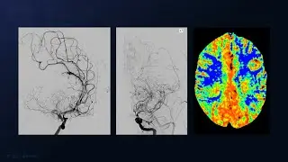 STA-M4 Bypass for Moyamoya Disease
