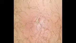 Cómo tratar y curar Ántrax