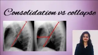 Chest X ray | How to differentiate consolidation from  collapse |