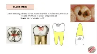 Quick Revision of G. V. Black's Classification of Dental Caries