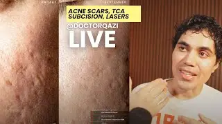 Dr. Qazi Unsponsored Live | Dr. Qazi discusses Acne Scars, Subcision, TCA Cross, Lasers | 9.11.2024