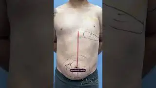 Poland Syndrome - Chest Fat Transfer