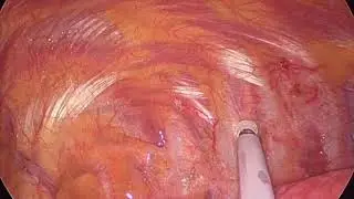 Uniportal VATS for bullectomy of left lower lobe