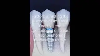 Three factors that may affect the success of implant placement#dental implants