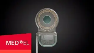 The MED-EL SYNCHRONY Cochlear Implant