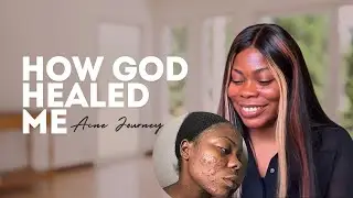 How God Healed Me | My Acne Journey Before & After
