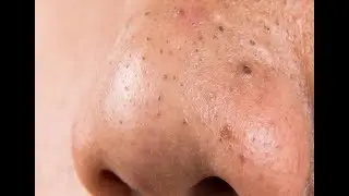 Выдавливание угрей ушными палочками