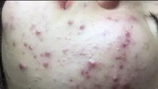 Acne Treatment Blackhead Extractions Popping #81