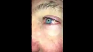 Red and painful eye. Can you see what is wrong? Answer will be posted at theEDexitVideo.com