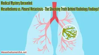 Mesothelioma vs Pleural Metastasis Radiology - Malignant Pleural Mesothelioma