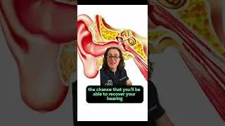 🧏 Sudden Sensorineural Hearing Loss (SSNHL) is the sudden loss of hearing for no apparent reason.