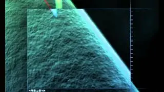 Medical animation - stent covering