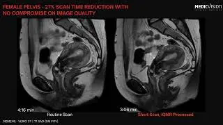 Female pelvis - 27% Scan time reduction with no compromise on image quality