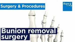 How bunion removal surgery is carried out | Bupa Health