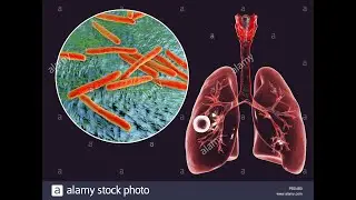 LA  TUBERCULOSIS