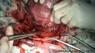 Caesarean section. Part 1