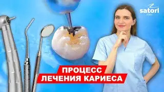 The process of caries treatment #dentistry #caries #dental treatment