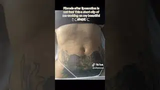 post liposuction massage