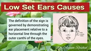 Low Set Ears Causes and Associated Anomalies | Pediatrics