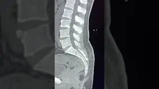 Fracture or something else ?