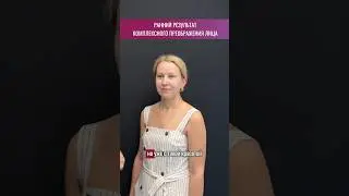 Выполнены: эндоскопия лба, круговая блефаропластика, подтяжка средней трети лица