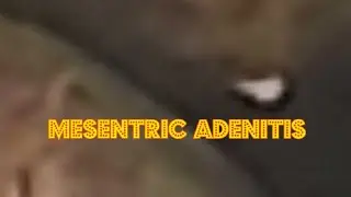 Mesentric Lymphadenopathy ( Non Specific)