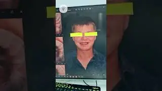 К 30 годам у пациента разрушились почти все свои зубы. Имплантация зубов.