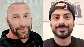 Patricks DHI Haartransplantation | Tag 1 bis 17 | Erfahrung