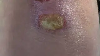 Bad Knee infection from a fall one week ago.