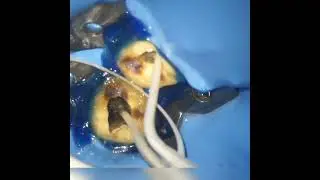 How to place Calcium  hydroxide using intracanal tip #shorts #ytshorts
