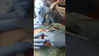 Лазерная шлифовка