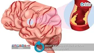 Beyin kanaması riskini arttıran nedenler nelerdir? 