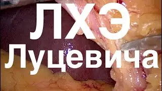как Луцевич делает ЛХЭ // холецистэктомия мастера // лапароскопическая холецистэктомия