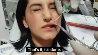 Üst Dudak | Monroe | Piercing Delim Sonrası İlk Değişim?