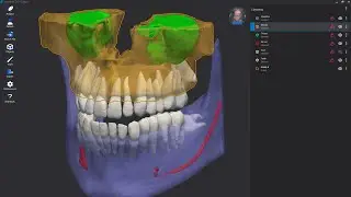🇬🇧 Implant 3D Jarvis_Artificial intelligence in dentistry