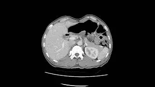 ulcer perforation