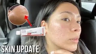 Using Tretinoin...UPDATE