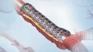 AERO® Fully Covered Tracheobronchial Stent Video