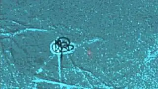 Zamykanie tętniaka metodą embolizacji .wmv